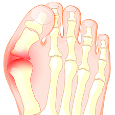 Foot with Bunion Foot with Bunion
