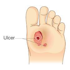 Foot with Ulcer