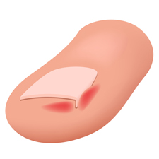 Toe with Ingrown Nail